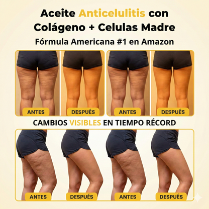 DermaLuxe™| Elimina estrías y da firmeza a la piel